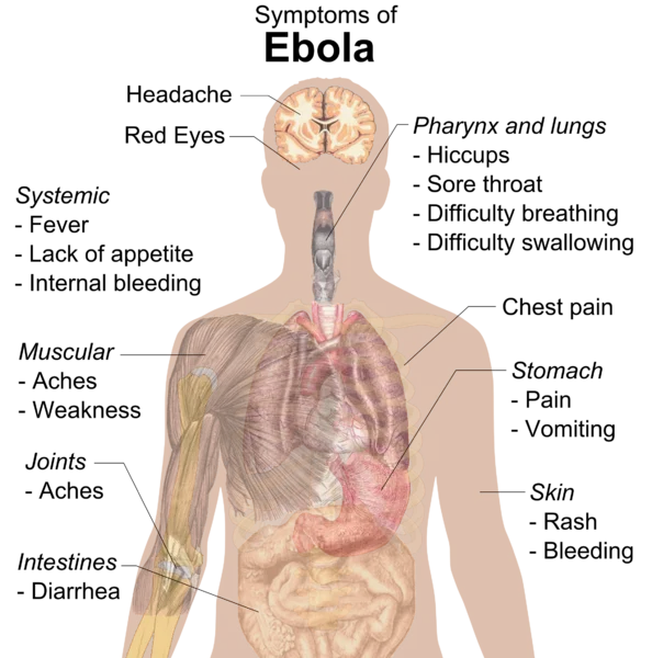 A medical diagram detailing the symptoms of Ebola virus disease circulated widely during the 2014 outbreak.