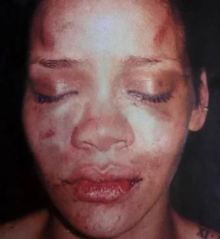 The infamous 2009 police photograph of Rihanna's injuries that made the Chris Brown assault case a major news story.