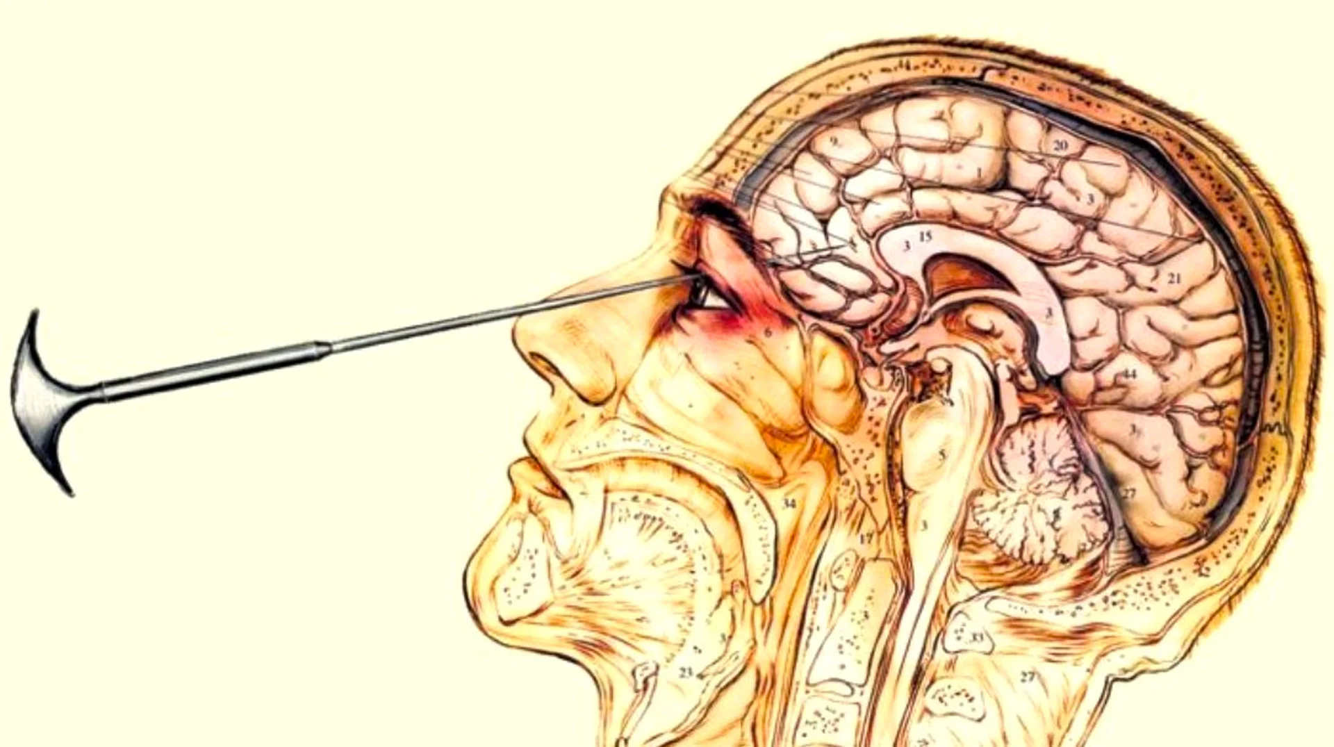 A medical diagram illustrating the transorbital lobotomy procedure, which became a reference point for the 'lobotomy' slang trend.