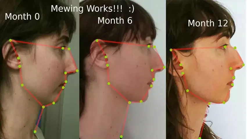 Progressive 12-month facial transformation claimed from mewing.