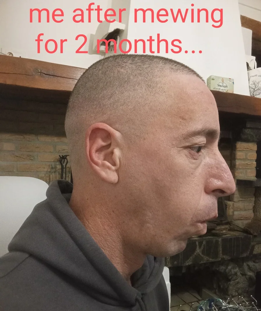 Purported rapid facial transformation results from mewing.