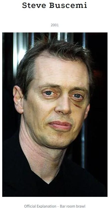 Steve Buscemi photographed in 2001 with a black eye, later attributed to a bar room brawl.